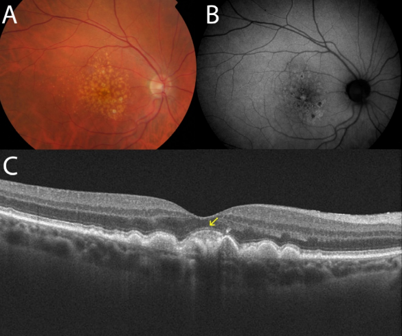 optical-coherence-tomography-age-related-macular-degeneration-image24.png