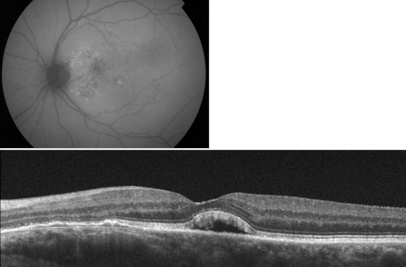 optical-coherence-tomography-age-related-macular-degeneration-image25.png