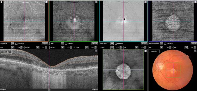 optical-coherence-tomography-age-related-macular-degeneration-image29.png