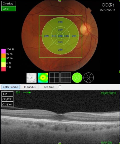 optical-coherence-tomography-age-related-macular-degeneration-image30.png