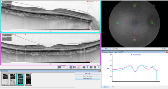 optical-coherence-tomography-age-related-macular-degeneration-image33.png