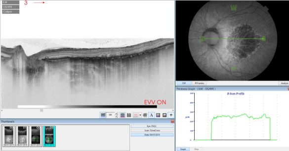 optical-coherence-tomography-age-related-macular-degeneration-image36.png