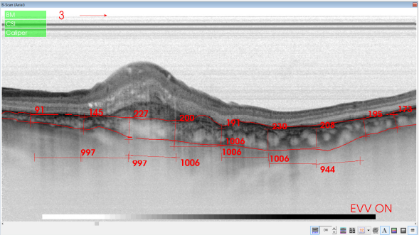 optical-coherence-tomography-age-related-macular-degeneration-image39.png
