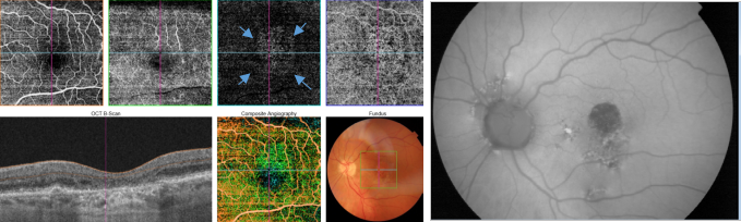 optical-coherence-tomography-age-related-macular-degeneration-image41.png