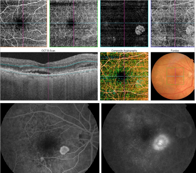 optical-coherence-tomography-age-related-macular-degeneration-image45.png