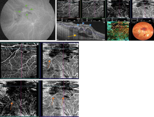 optical-coherence-tomography-age-related-macular-degeneration-image47.png