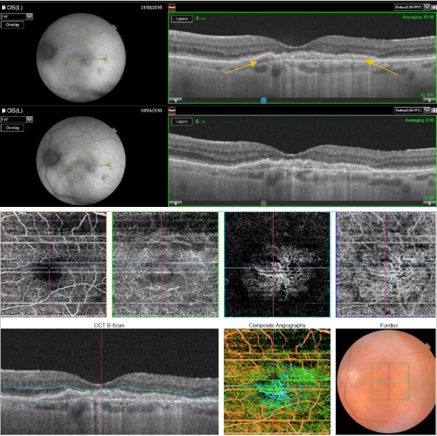 optical-coherence-tomography-age-related-macular-degeneration-image51.png