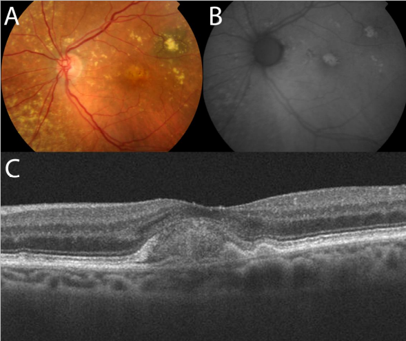 optical-coherence-tomography-age-related-macular-degeneration-image23.png