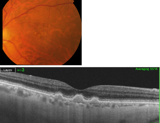 optical-coherence-tomography-age-related-macular-degeneration-image31.png