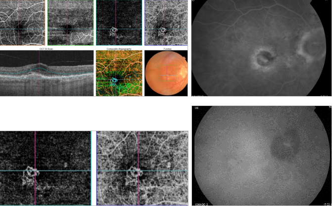 optical-coherence-tomography-age-related-macular-degeneration-image44.png