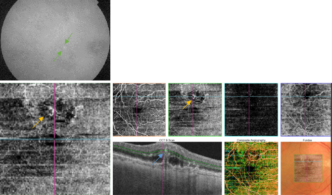 optical-coherence-tomography-age-related-macular-degeneration-image46.png
