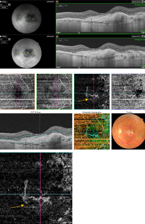 optical-coherence-tomography-age-related-macular-degeneration-image48.png