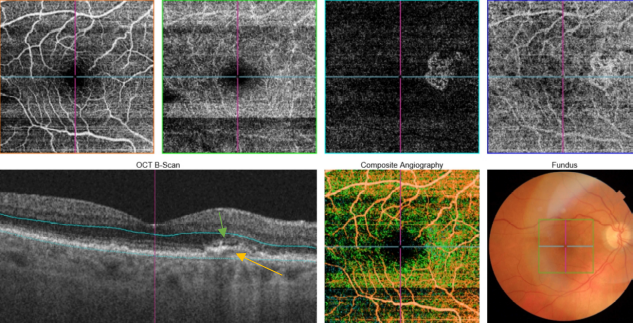 optical-coherence-tomography-age-related-macular-degeneration-image53.png