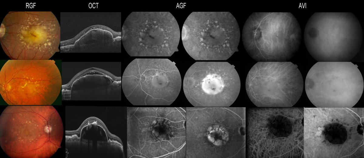 Diagnostic usefulness of indocyanine green angiography (ICGA) in age ...